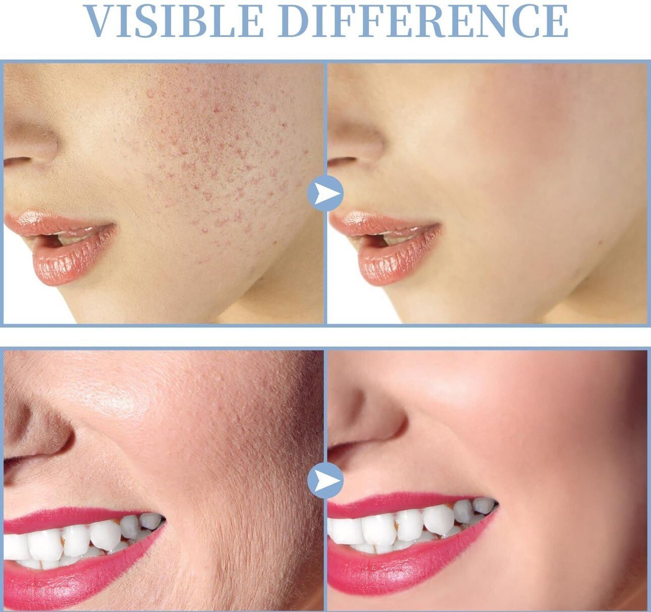 Appareil à Haute Fréquence TUMAKOU - Stimulation Faciale Santé - Image 4